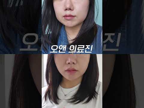 3일만에 얼굴살 파괴 윤곽주사: O에서 N으로, 오앤 각주사