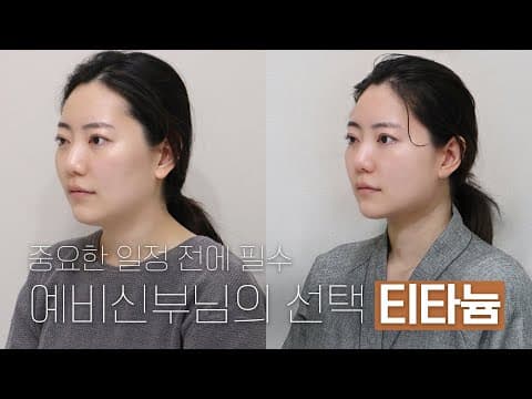 결혼을 앞둔 예비신부님의 선택 티타늄 리프팅: 중요한 일정 전 필수