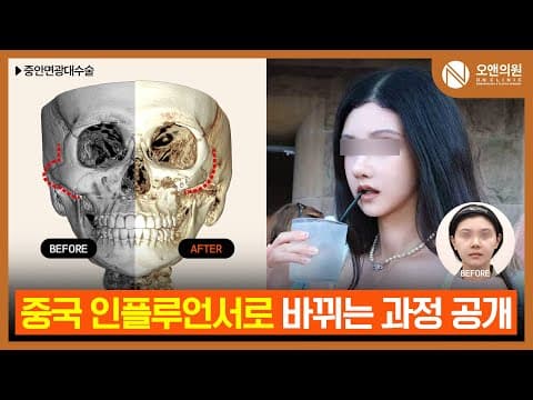 중안면 광대수술 중국 환자 후기: 인플루언서로 바뀌는 과정