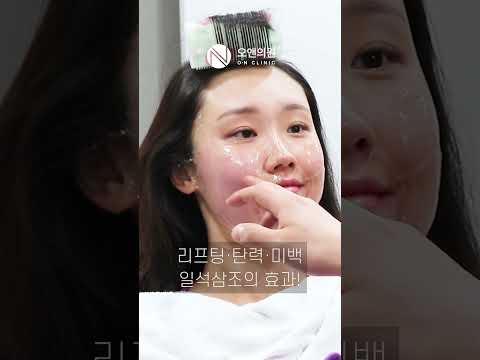 오앤 티타늄 리프팅 레이저: 패임 걱정 없는 일석삼조 효과
