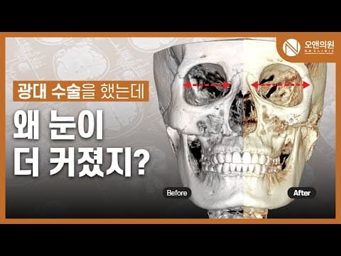 광대중안면축소수술 비대칭 교정: 광대 수술로 눈도 커진 사례