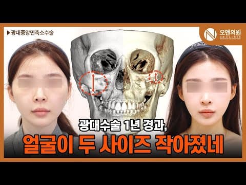 오앤 안면윤곽 광대중안면축소수술: 1년 경과 두 사이즈 작아진 얼굴