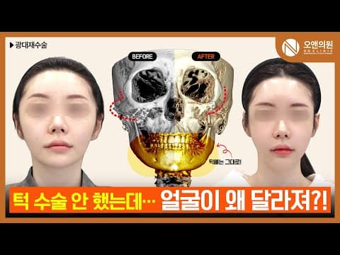 Zygoma Revision: Facial Proportion and Impression Change Without Chin Surgery