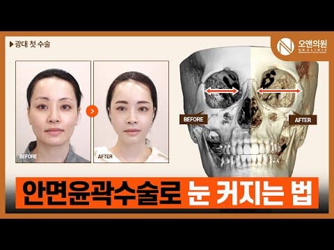 오앤 안면윤곽 광대중안면축소수술: 광대 첫수술로 눈 커지는 법