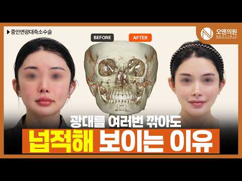 중안면 광대 축소 수술로 밋밋한 얼굴을 입체적인 동안으로 변화
