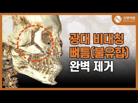 오앤안면윤곽 광대 비대칭, 뼈틈 (불유합) 완벽 제거 사례