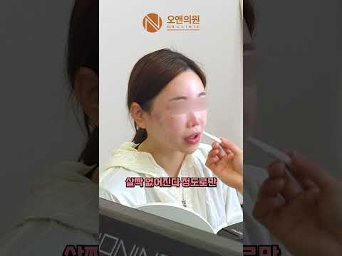 안면윤곽 수술로 얼굴이 3cm 이상 짧아진 환자: OOO광대로 짧아짐