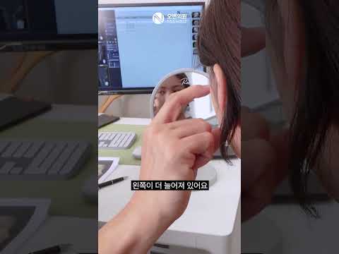 안면 비대칭 개선을 위한 광대 축소 수술: 환자도 만족한 사례