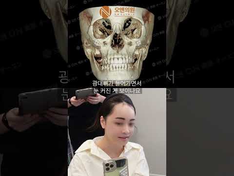 광대 비대칭 교정으로 눈이 커지는 효과: 광대 첫수술 후기