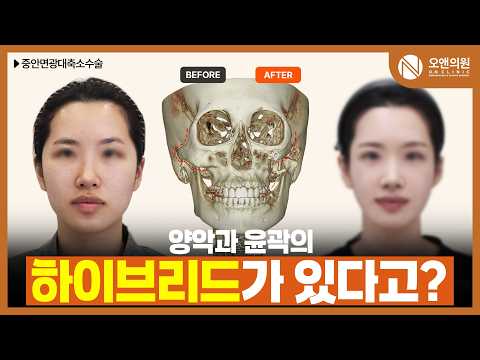중안면 광대 축소 수술로 얼굴 비율 개선: 양악·윤곽 하이브리드