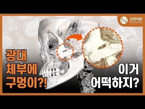 頬骨再手術（頬骨体部の骨欠損へ骨移植）：穴の開いた頬骨どうする？