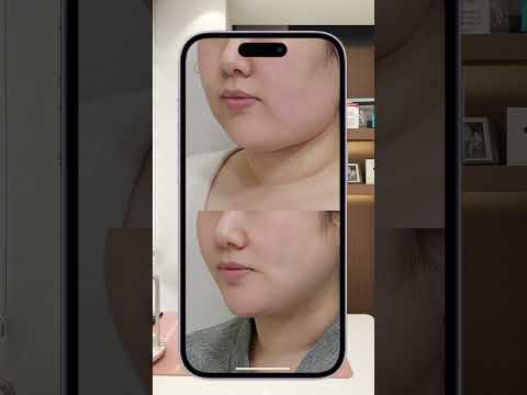 오앤의원 비만/윤곽 수술 전후 비교: 예쁨 예약 완료 후기