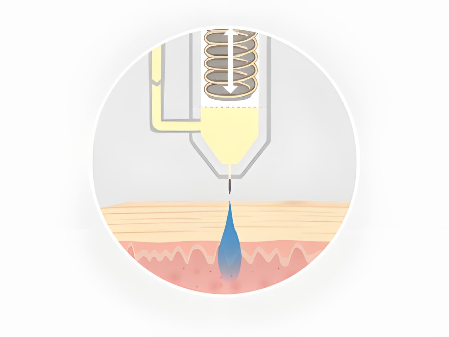STEP 03: 미세젯 분사