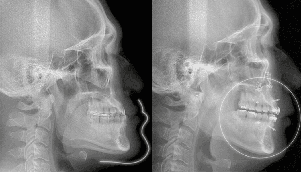 3 months post-surgery, jaw surgery without orthodontics