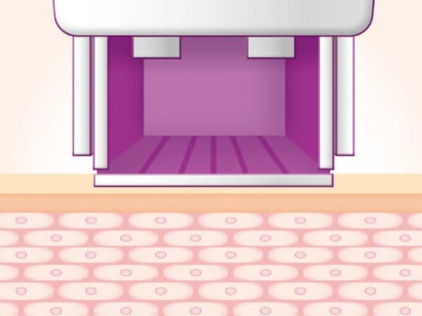 STEP 01: 시술팁 안착