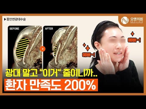 ON Midface Cheekbone Surgery: Reduce This, Not the Cheekbone