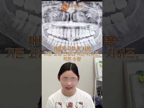 광대 재수술, 26개 핀 제거 후 안전한 절골과 뼈이식
