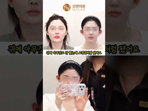 뼈대부터 다른 얼굴형 변화! 네모형 얼굴이 요정처럼 변신