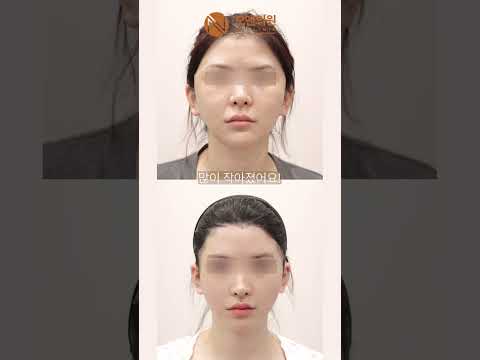 Cheekbone Protrusion Improved After Thread Lift and Midface Reduction