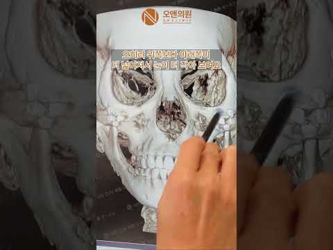 Misconceptions and truths about zygoma surgery: why faces look wider