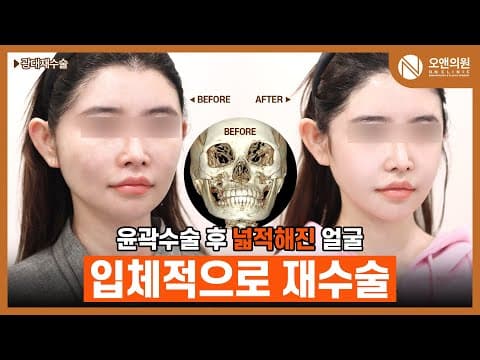 광대 재수술 넙적한 얼굴과 비대칭 개선: 입체 재수술로 솔루션