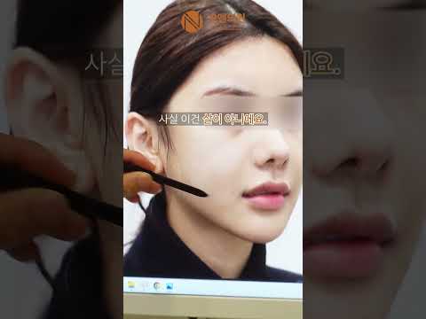윤곽 수술 후 볼살 지방 흡입은 절대 안 됩니다!