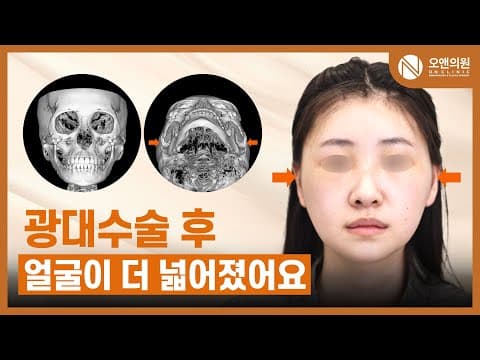 오앤 안면윤곽 광대중안면축소수술: 광대수술 후 얼굴이 더 넓어진 사례
