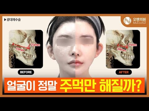 광대재수술 3개월 경과: 얼굴이 주먹만 해진 후기