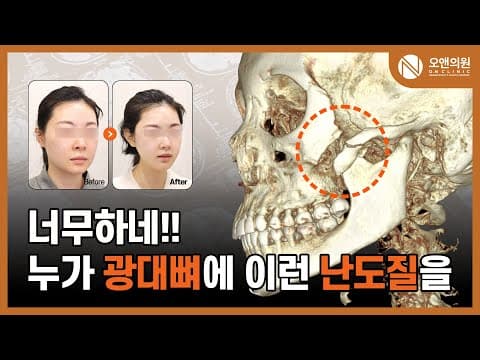 광대 재수술 (10mm 뼈틈): 광대뼈 난도질, 뼈틈 재건 사례