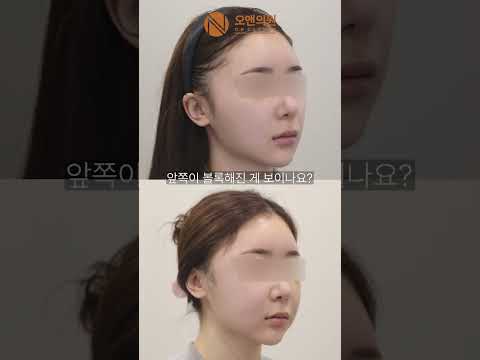 Large Head Concerns: How the Face Looks Smaller After Zygoma Reduction
