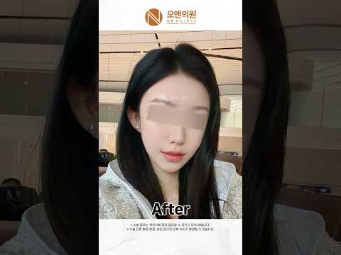 Smaller Face After Reoperation and Thread Lift Side Effect Care: 1 Year