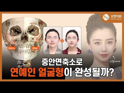 頬骨中顔面縮小術:中顔面縮小で芸能人のような顔の形になれるのか?