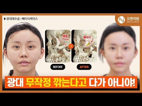 광대 재수술 (뼈틈): 무작정 깎아 생긴 뼈틈, 뼈이식 재건 사례