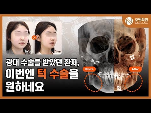 オーアン顔面輪郭Vライン手術レビュー:頬骨手術後にVラインを追加した事例