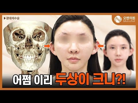 오앤 안면윤곽 광대재수술: 어쩜 이리 두상이 크니? 사례