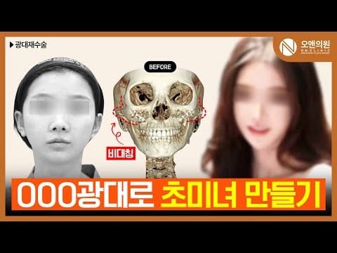 오앤의원 광대뼈 비대칭 교정 및 축소 수술 후기: 초미녀 만들기