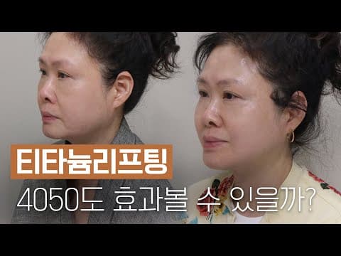 4050 세대도 효과 볼 수 있는 티타늄 리프팅 후기