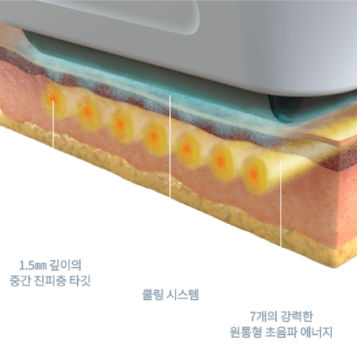 진피 중간층 1.5mm 타겟